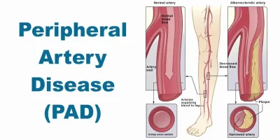 Understanding Peripheral Artery Disease: Is It Considered a Disability?