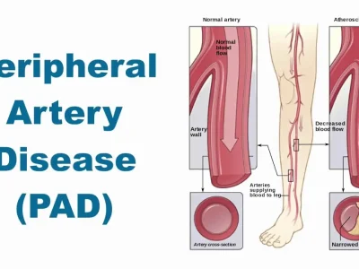 Understanding Peripheral Artery Disease: Is It Considered a Disability?